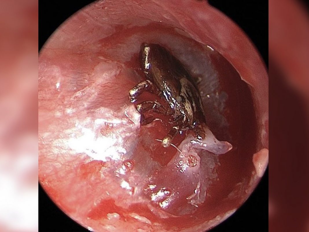 A Young Boy Heard a Buzzing Noise in His Ear. It Was a Tick on His Eardrum.